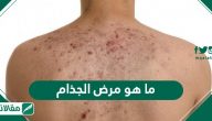 ما هو مرض الجذام