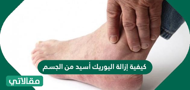 كيفية إزالة اليوريك أسيد من الجسم