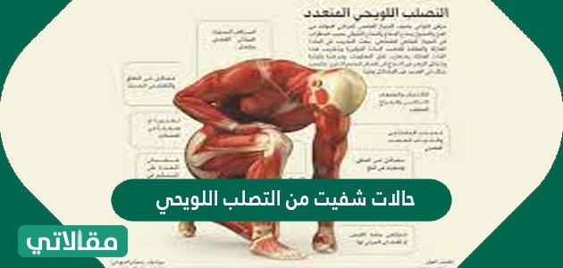 حالات شفيت من التصلب اللويحي