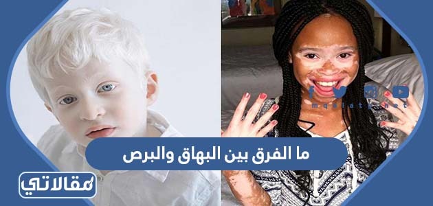 ما الفرق بين البهاق والبرص