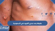 حقيقة رصد جدري القرود في السعودية