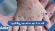 كم مدة حجر مصاب جدري القرود