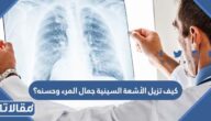 كيف تزيل الأشعة السينية جمال المرء وحسنه؟