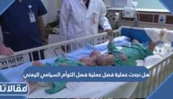 هل نجحت عملية فصل التوأم السيامي اليمني