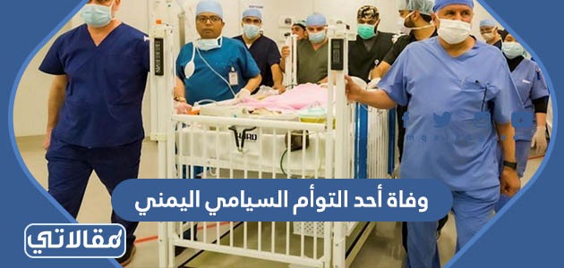 وفاة أحد التوأم السيامي اليمني