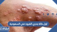 تفاصيل رصد اول حالة جدري القرود في السعودية