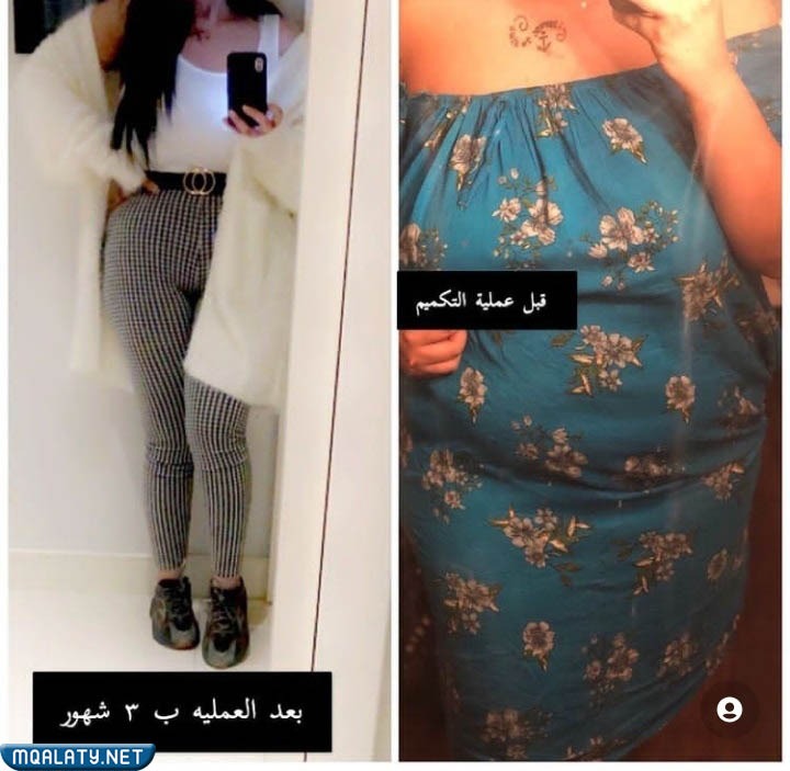صور يوشي عبدالله قبل التكميم