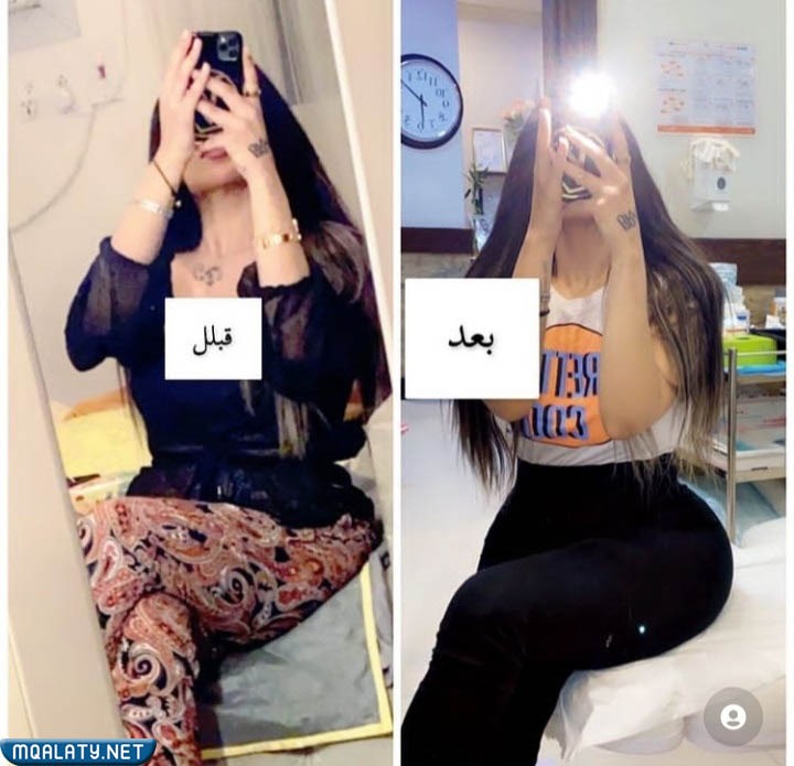 صور يوشي عبدالله قبل التكميم