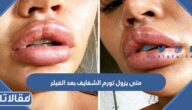متى يزول تورم الشفايف بعد الفيلر