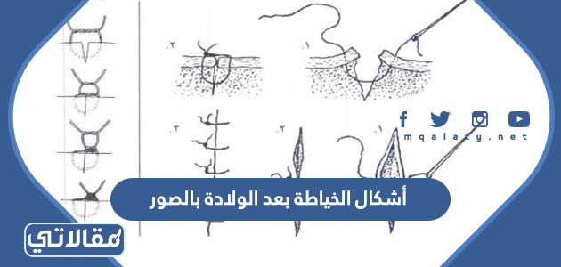 أشكال الخياطة بعد الولادة بالصور