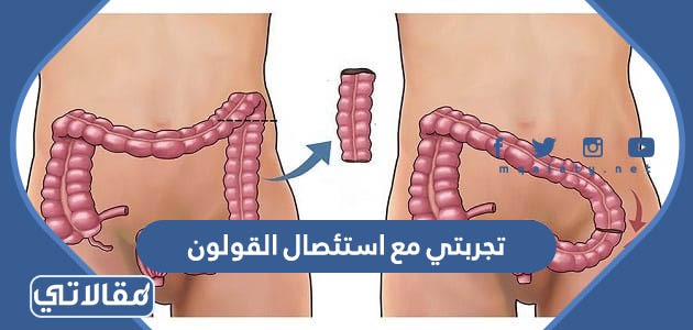 تجربتي مع استئصال القولون