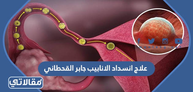 علاج انسداد الانابيب جابر القحطاني