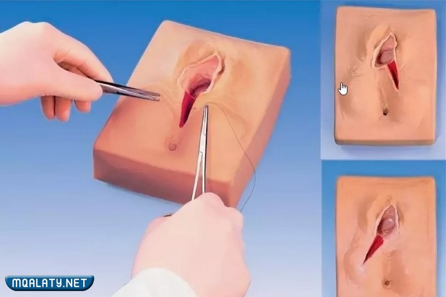 أشكال الخياطة بعد الولادة بالصور