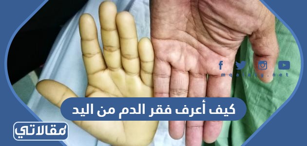 كيف أعرف فقر الدم من اليد