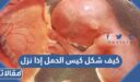 كيف شكل كيس الحمل إذا نزل