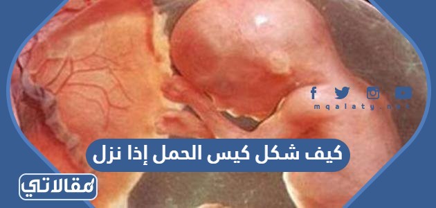 كيف شكل كيس الحمل إذا نزل