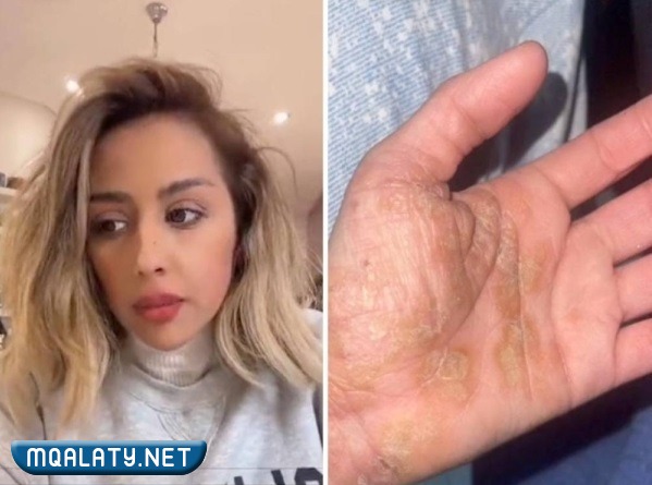 ما هو مرض فرح الهادي