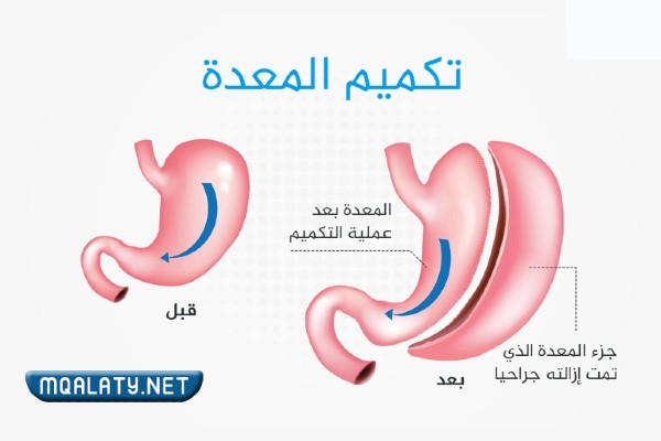 تجارب عملية التكميم في مستشفى السعودي الألماني